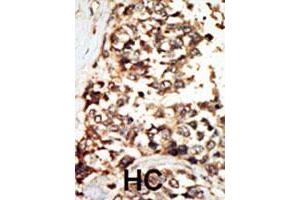 Formalin-fixed and paraffin-embedded human hepatocellular carcinoma tissue reacted with the PKD2 polyclonal antibody  , which was peroxidase-conjugated to the secondary antibody, followed by DAB staining. (PKD2 antibody  (C-Term))