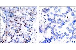 Immunohistochemistry analysis of paraffin-embedded human breast carcinoma tissue, using c-Jun (Ab-91) Antibody. (C-JUN antibody  (AA 58-107))