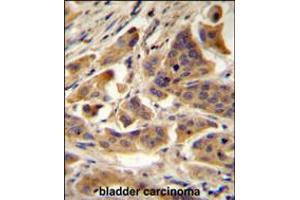 RBCK1 (UBCE7IP3) Antibody immunohistochemistry analysis in formalin fixed and paraffin embedded human bladder carcinoma followed by peroxidase conjugation of the secondary antibody and DAB staining.