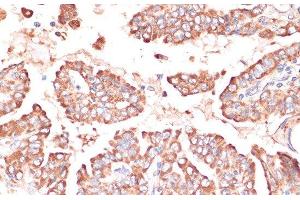 Immunohistochemistry of paraffin-embedded Human thyroid cancer using FRMD6 Polyclonal Antibody at dilution of 1:100 (40x lens). (FRMD6 antibody)