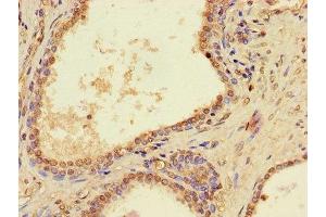 Immunohistochemistry of paraffin-embedded human prostate cancer using ABIN7162746 at dilution of 1:100 (PTCD2 antibody  (AA 153-388))