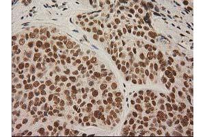 Immunohistochemical staining of paraffin-embedded Adenocarcinoma of Human breast tissue using anti-LOX mouse monoclonal antibody. (LOX antibody  (AA 22-168))