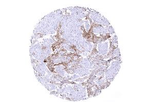 Breast Breast cancer NST with PD L1 negative tumor cells but intense PD L1 staining in tumor associated inflammatory cells (Recombinant PD-L1 antibody)