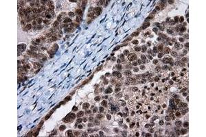 Immunohistochemical staining of paraffin-embedded Adenocarcinoma of breast tissue using anti-SRR mouse monoclonal antibody.