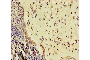 Immunohistochemistry of paraffin-embedded human lung cancer using ABIN7166936 at dilution of 1:100 (R-Spondin 3 antibody  (AA 22-272))