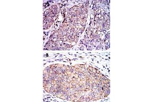 Immunohistochemical analysis of paraffin-embedded human lung cancer (A) and human kidney cancer (B) tissue using SERPINE1 monoclonal antobody, clone 1D5  with DAB staining.