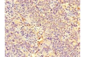 Immunohistochemistry of paraffin-embedded human cervical cancer using ABIN7163856 at dilution of 1:100