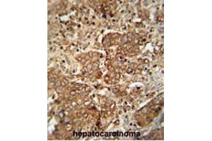 APCS antibody (C-term) immunohistochemistry analysis in formalin fixed and paraffin embedded human hepatocarcinoma followed by peroxidase conjugation of the secondary antibody and DAB staining. (APCS antibody  (C-Term))