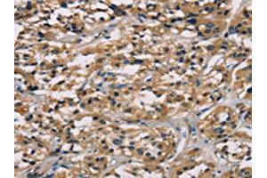 The image on the left is immunohistochemistry of paraffin-embedded Human thyroid cancer tissue using ABIN7128926(CGA Antibody) at dilution 1/65, on the right is treated with fusion protein. (CGA antibody)