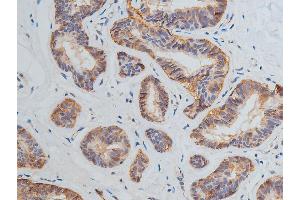 ABIN6269228 at 1/200 staining human breast cancer tissue sections by IHC-P. (VEGFR2/CD309 antibody)