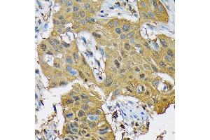 Immunohistochemistry of paraffin-embedded human lung cancer using RPB3/POLR2C Rabbit mAb (ABIN7269458) at dilution of 1:100 (40x lens). (POLR2C antibody)