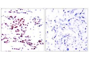 Immunohistochemical analysis of paraffin- embedded human breast carcinoma tissue using STAT5A (Ab-780) antibody (E021049). (STAT5A antibody)
