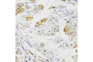 Immunohistochemistry of paraffin-embedded human uterine cancer using MLKL antibody (ABIN6134395, ABIN6143882, ABIN6143886 and ABIN6217454) at dilution of 1:100 (40x lens).