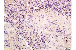 Formalin-fixed and paraffin embedded human gastric carcinoma labeled with Anti-CPSF4/CPSF30 Polyclonal Antibody, Unconjugated (ABIN1386751) at 1:200 followed by conjugation to the secondary antibody and DAB staining (CPSF4 antibody  (AA 81-180))