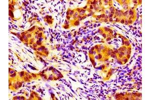 IHC image of ABIN7161386 diluted at 1:100 and staining in paraffin-embedded human pancreatic cancer performed on a Leica BondTM system. (NPAS2 antibody  (AA 644-763))