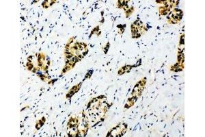 IHC-P: Splicing factor 1 antibody testing of human lung cancer tissue (Splicing Factor 1 antibody  (N-Term))