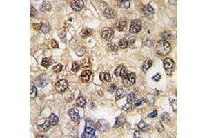 IHC analysis of FFPE human hepatocarcinoma tissue stained with RUNX2 antibody (RUNX2 antibody  (AA 1-30))