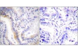 Immunohistochemistry analysis of paraffin-embedded human lung carcinoma tissue, using Urocortin Antibody. (Urocortin antibody  (AA 71-120))