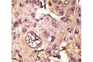 IHC analysis of FFPE human hepatocarcinoma tissue stained with the TAU antibody (tau antibody  (AA 677-707))