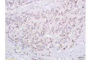Formalin-fixed and paraffin embedded human endometrium tissue labeled with Anti-P73 Polyclonal Antibody, Unconjugated (ABIN675279) followed by conjugation to the secondary antibody and DAB staining