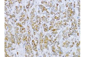 Immunohistochemistry of paraffin-embedded Human colon carcinoma using Aconitase 2  antibody (ABIN1678537, ABIN3017991, ABIN3017992 and ABIN6220329) at dilution of 1:100 (40x lens). (ACO2 antibody  (AA 501-780))