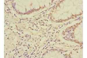 Immunohistochemistry of paraffin-embedded human colon cancer using ABIN7174422 at dilution of 1:100 (UBAP1 antibody  (AA 1-300))