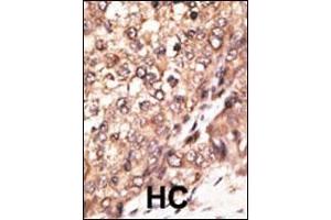 Formalin-fixed and paraffin-embedded human cancer tissue reacted with the primary antibody, which was peroxidase-conjugated to the secondary antibody, followed by DAB staining. (BMP7 antibody  (N-Term))