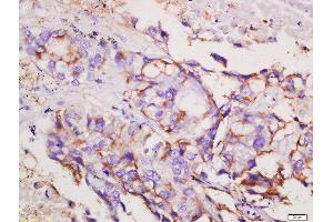 Formalin-fixed and paraffin embedded human lung carcinoma labeled with Rabbit Anti-CCR6/CD196 Polyclonal Antibody, Unconjugated  at 1:200 followed by conjugation to the secondary antibody and DAB staining (CCR6 antibody  (AA 201-300))