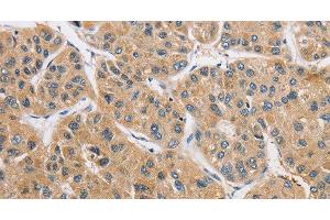 Immunohistochemistry of paraffin-embedded Human liver cancer using ARHGAP15 Polyclonal Antibody at dilution of 1:50 (ARHGAP15 antibody)