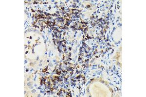 Immunohistochemistry of paraffin-embedded human thyroid cancer using PIK3CG Rabbit pAb (ABIN6130600, ABIN6145638, ABIN6145639 and ABIN6222396) at dilution of 1:100 (40x lens). (PIK3 gamma antibody  (AA 1-200))