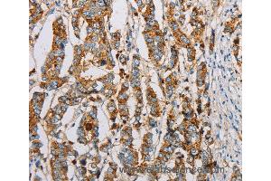 Immunohistochemistry of Human breast cancer using IFITM3 Polyclonal Antibody at dilution of 1:20 (IFITM3 antibody)