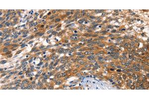 Immunohistochemistry of paraffin-embedded Human cervical cancer tissue using AGO1 Polyclonal Antibody at dilution 1:40 (AGO1 antibody)