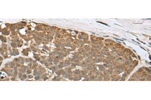 Immunohistochemistry of paraffin-embedded Human thyroid cancer tissue using SPRTN Polyclonal Antibody at dilution of 1:65(x200) (Spartan antibody)
