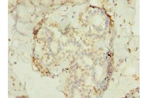 Immunohistochemistry of paraffin-embedded human breast cancer using ABIN7165522 at dilution of 1:100 (FAM53B antibody  (AA 1-305))