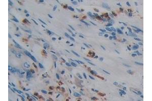 Detection of PTPRQ in Human Colorectal cancer Tissue using Polyclonal Antibody to Protein Tyrosine Phosphatase Receptor Type Q (PTPRQ)