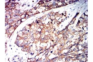Immunohistochemical analysis of paraffin-embedded bladder cancer tissues using SERPINA1 mouse mAb with DAB staining. (SERPINA1 antibody  (AA 269-419))