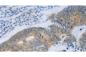Immunohistochemistry of paraffin-embedded Human colon cancer tissue using MT2A Polyclonal Antibody at dilution 1:40 (MT2A antibody)