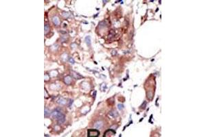 Formalin-fixed and paraffin-embedded human cancer tissue reacted with the primary antibody, which was peroxidase-conjugated to the secondary antibody, followed by AEC staining. (MUSK antibody  (C-Term))