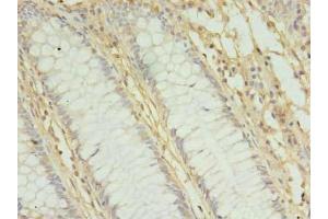 Immunohistochemistry of paraffin-embedded human colon cancer using ABIN7142391 at dilution of 1:100 (MRPL3 antibody  (AA 201-348))
