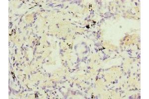 Immunohistochemistry of paraffin-embedded human lung cancer using ABIN7164323 at dilution of 1:100 (RARS2 antibody  (AA 17-340))