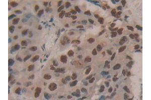 Detection of HDGF in Human Breast cancer Tissue using Polyclonal Antibody to Hepatoma Derived Growth Factor (HDGF)