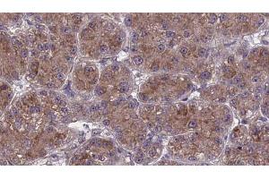 ABIN6273982 at 1/100 staining Human liver cancer tissue by IHC-P. (OR2T27 antibody  (Internal Region))