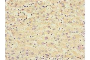 Immunohistochemistry of paraffin-embedded human liver cancer using ABIN7167664 at dilution of 1:100 (Relaxin 3 Receptor 1 antibody  (AA 1-80))