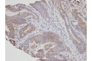 IHC-P Image Immunohistochemical analysis of paraffin-embedded human T(gastric cancer) , using NSMAF, antibody at 1:100 dilution. (NSMAF antibody)