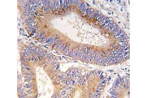 IHC analysis of FFPE human colon carcinoma tissue stained with GDF11 antibody (GDF11 antibody  (AA 32-61))