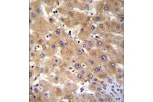 Immunohistochemistry analysis in formalin fixed and paraffin embedded human liver tissue reacted with GAGE12B Antibody (N-term) followed by peroxidase conjugation of the secondary antibody and DAB staining. (G Antigen 12B antibody  (N-Term))