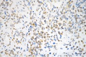 Immunohistochemistry was performed on paraffin-embedded human glioblastoma using QKI antibody (ABIN7800036), 1:200).