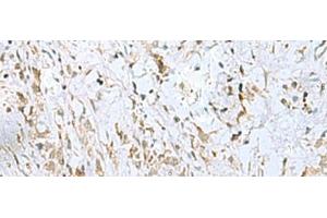 Immunohistochemistry of paraffin-embedded Human gastric cancer tissue using ECT2 Polyclonal Antibody at dilution of 1:35(x200)