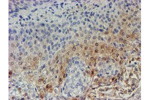 Immunohistochemical staining of paraffin-embedded Carcinoma of Human bladder tissue using anti-C17orf37 mouse monoclonal antibody.