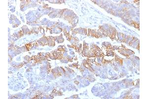 Formalin-fixed, paraffin-embedded human Colon Carcinoma stained with E-Cadherin Mouse Recombinant Monoclonal Antibody (rCDH1/1525). (Recombinant E-cadherin antibody)